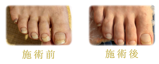 足と爪のお手入れ 施術例 1