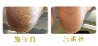 足の角質ケア 施術例 3