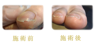 足と爪のお手入れ 施術例 2