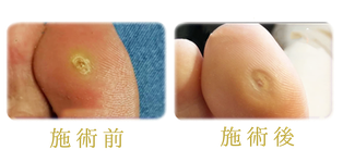足の角質ケア 施術例 4