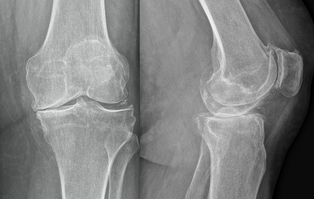 Gonarthrose