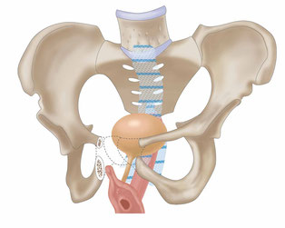 ダブルメッシュ腹腔鏡下仙骨腟固定術のイラスト
