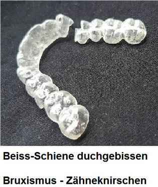 Beiss-Schiene kaputtgebissen mit Loch, Bruxismus, Zähneknirschen, CMD