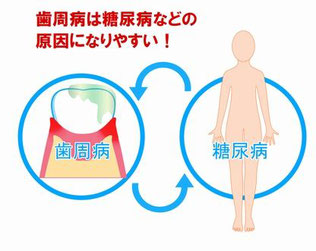 歯周病と糖尿病