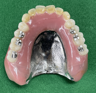 金属床金属義歯