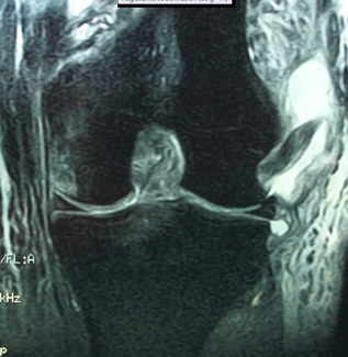 Abb.: Kompletter Riss des lateralen Kapselbandapparates (Multi-Ligamentverletzung inkl. der Kreuzbänder)