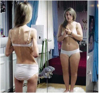 Se observa una clara distorsión de la imagen corporal. La persona está extremadamente flaca, por debajo de su peso recomendado, pero de todas maneras se ve por encima de su peso normal.