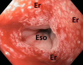 Erosion pattern after removal of an intraluminal openpore polyurethane-foam drainage are an important sign of correct function of therapy.