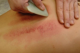 Gua-Sha-Behandlung