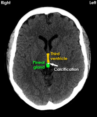 Pineal gland, calcification, Third ventricle