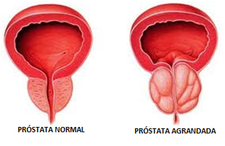CRECIMIENTO PROSTÁTICO