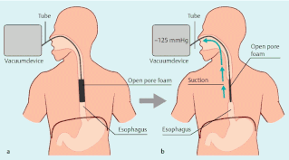 Principle of intraluminal EVT in esophagus: lumen of esophagus is closed with suction.