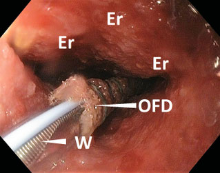 Endoscopic insertion of an open-pore film drainage (OFD), ersosion pattern (Er) after ENPT with OPD, tube with guidewire (W)