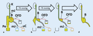 Schematic representation of the therapy, urine was drained in an active manner with negative pressure.