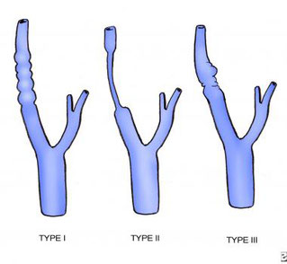 Types of fibromuscular dysplasia (FMD), type I, type II, type III