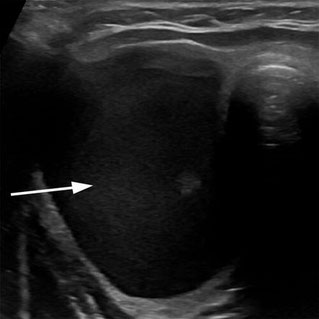 Sonographische Darstellung eines Schilddrüsenknotens mit weit überwiegend flüssigen (zystischen) Anteilen (Pfeil). Diese Form der Schilddrüsenknoten ist besonders gut für die minimal-invasive Behandlung mittels Thermoablation geeignet.