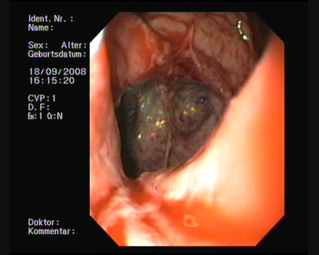 Boerhaave perforation of distal esophagus