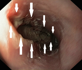 long ruptur of esophagus