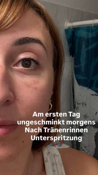 Augenringe Tränenrinne München