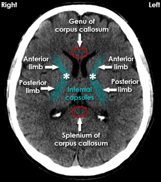 Genu of corpus callosum, Splenium of corpus collosum, Internal capsules (posterior + anterior limb)