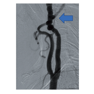 digital subtraction angiography (DSA) in a patient with FMD