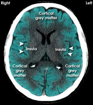 Cortical grey matter, Insula