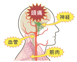 頭痛の原因は首のコリと血行不良です。