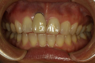 インプラントの歯茎が下がって黒く見えるケース　治療前