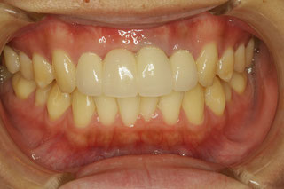 歯茎の黒い場合の審美歯科治療ケース　治療後　