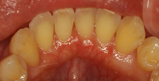 下の前歯の裏側の歯茎の再生治療後