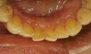 下の前歯の裏側の歯茎の再生治療後