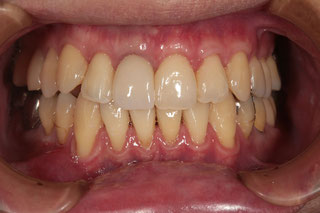 歯茎の再生治療後　
