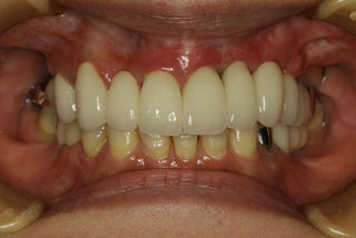 インプラントの歯茎再生治療後