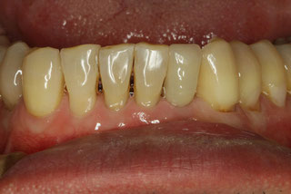 歯と歯の間の隙間の治療　まずは歯茎の再生治療後