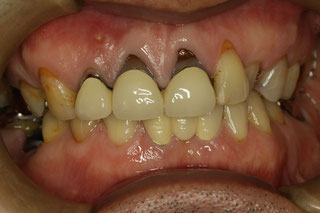 差し歯の歯茎が黒い場合　治療前