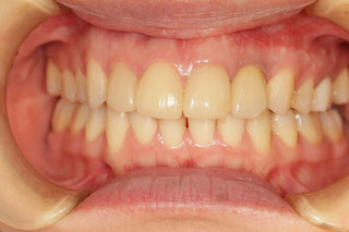 インプラントの歯茎再生治療後
