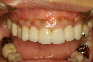 セラミックブリッジの長さを短くしたケース　治療後
