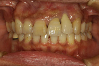 インプラントの歯茎再生　治療前