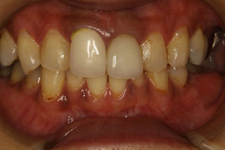 セラミックの長さを短くしたケース　治療前