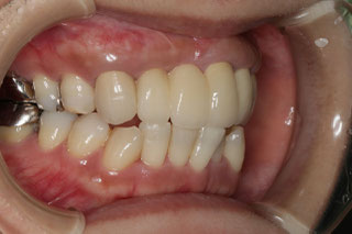 ブリッジの長さを改善したケース　治療後