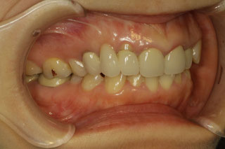 セラミックの長さを短くしたケース　治療前