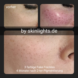 Collage C – vorher, direkt danach, 4 Monate nach 2. Behandlung