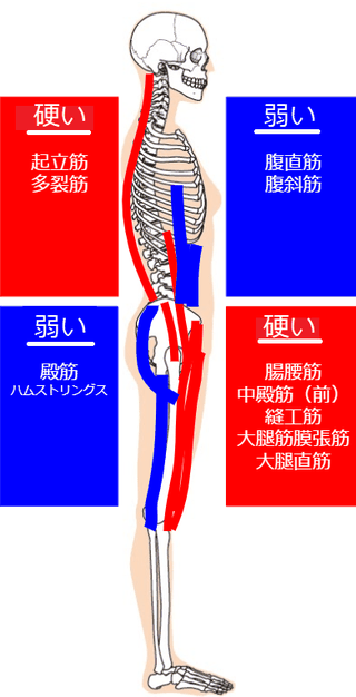 腰痛｜反り腰（下位交差症候群）