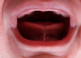 Das zu kurze Zungenbändchen- ein Problem beim Stillen und für die ...