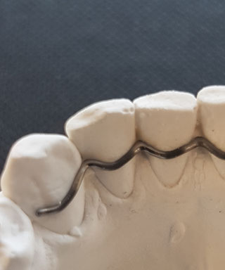 Retainer Cad Cam gefräst - Gutzwiller Dental
