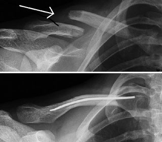 Schlüsselbeinbruch (Klavikulafraktur) - ortho-clinics Webseite!