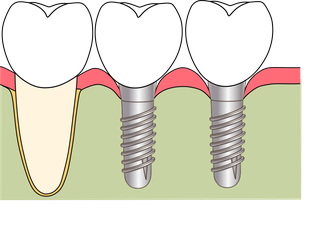 下顎奥歯のインプラント