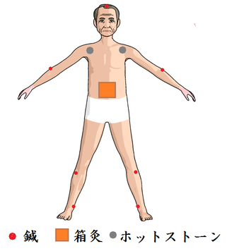 帯状疱疹後神経痛施術例（前面）