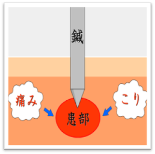 針先でこりを捕えます