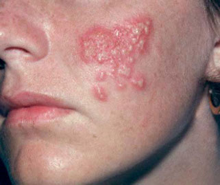 Herpes infection